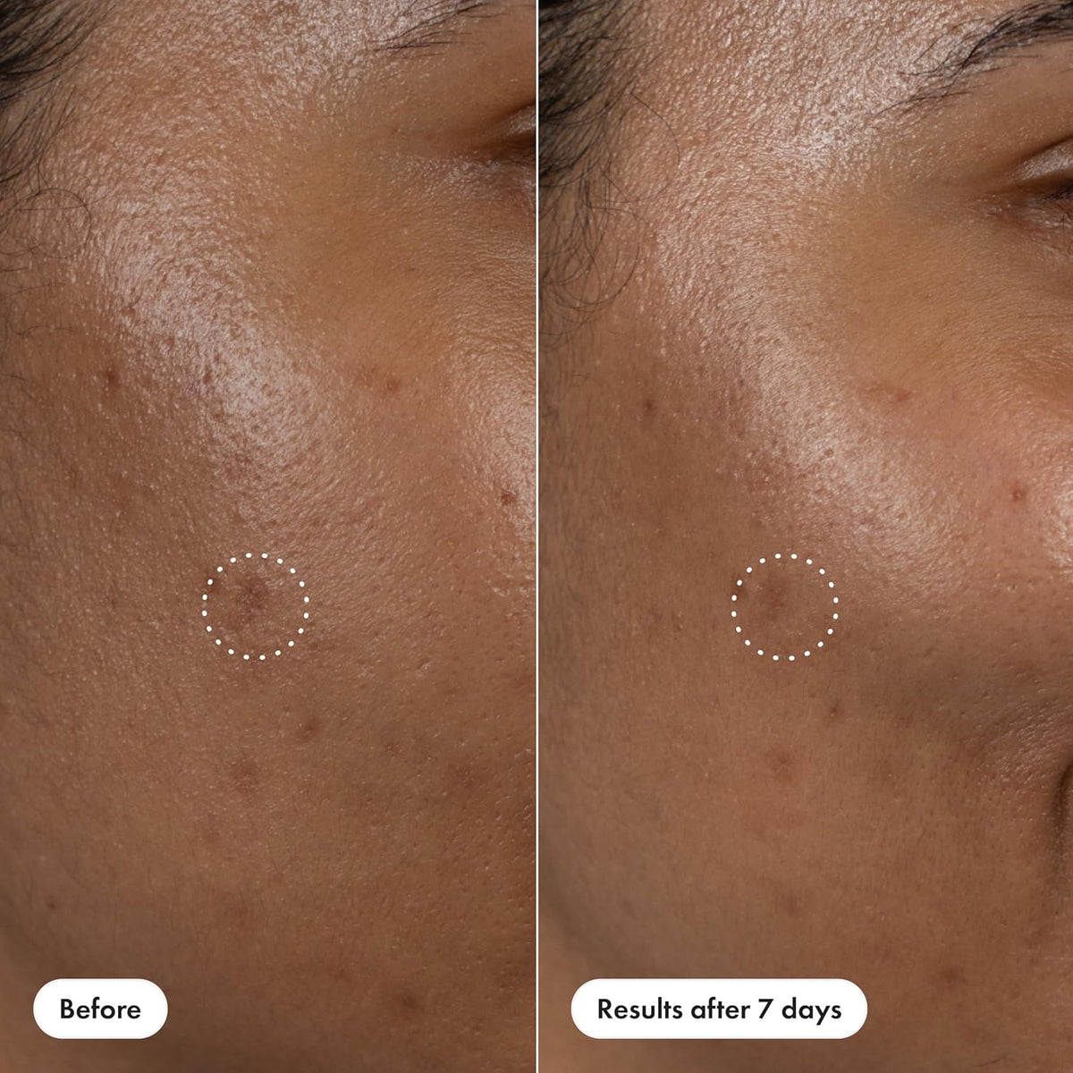 Hero Cosmetics Dark Spot Correct – Non-Comedogenic Brightening Pen Safe for Sensitive, Blemish-Prone Users