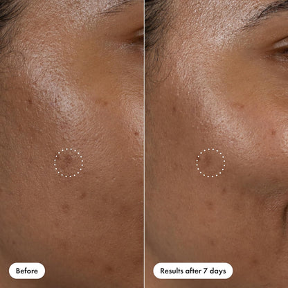 Hero Cosmetics Dark Spot Correct – Non-Comedogenic Brightening Pen Safe for Sensitive, Blemish-Prone Users