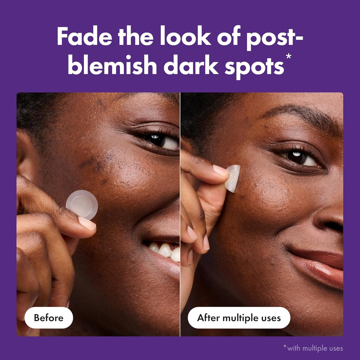 Hero Cosmetics Mighty Patch Hero Micropoint Spot Treatment – Beautiful Housewarming Present for the Friend Who Loves Beauty