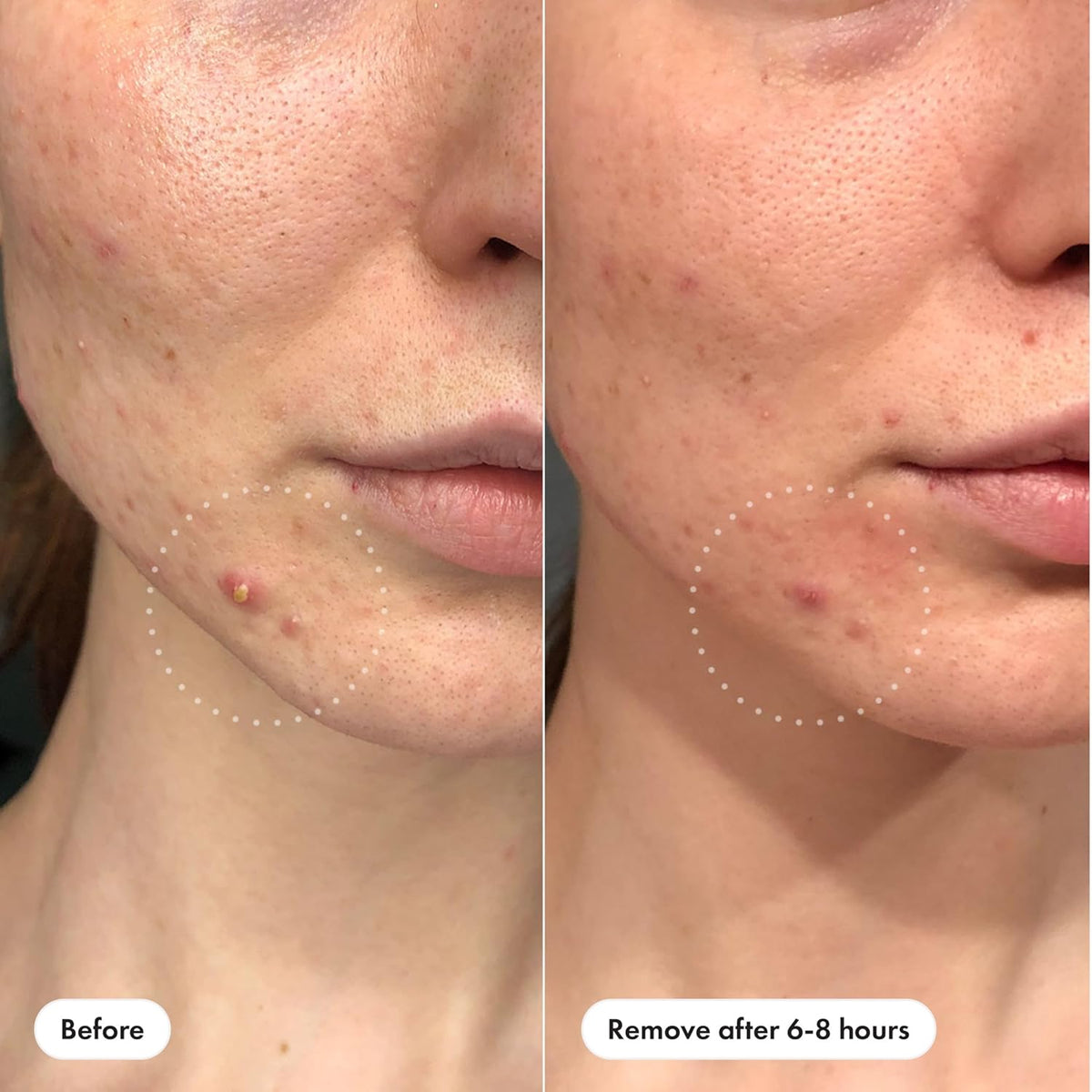 medical-grade hydrocolloid that gently absorbs pus and oil from whiteheads