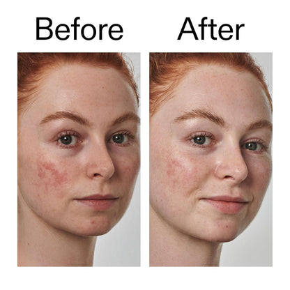 The INKEY List SuperSolutions Azelaic Acid 10% Serum – Mindful AM/PM Skincare Ritual for Even-Toned Skin